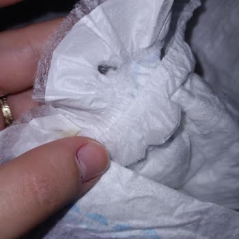 Bebek Bezinde Çıkan Siyah Yabancı Cisim Endişesi