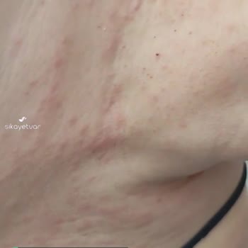 Adana Özveri Kozmetik Alerji Yapan Bioness Keratin
