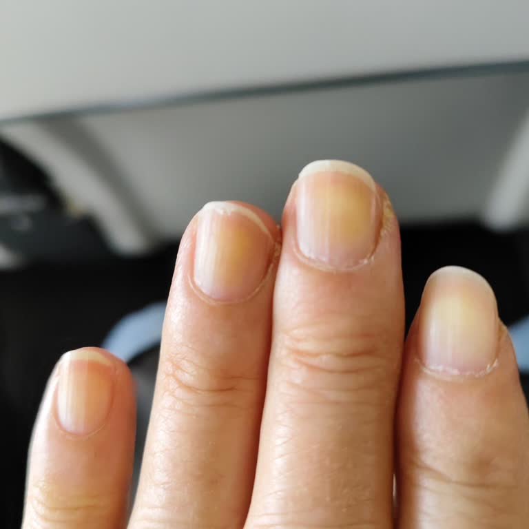 Flormar Oje Sonrası Tırnaklarda Sararma Ve Ciltte Beyazlanma Sorunu