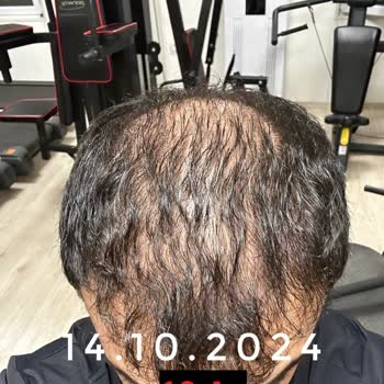 Emphair Saç Ekim Merkezi Saç Ekimi Sonrası Başarısız Sonuç ve Mağduriyet
