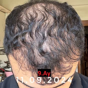 Emphair Saç Ekim Merkezi Saç Ekimi Sonrası Başarısız Sonuç ve Mağduriyet