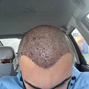 Emphair Saç Ekim Merkezi Saç Ekimi Sonrası Başarısız Sonuç ve Mağduriyet