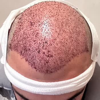 Emphair Saç Ekim Merkezi Saç Ekimi Sonrası Başarısız Sonuç ve Mağduriyet