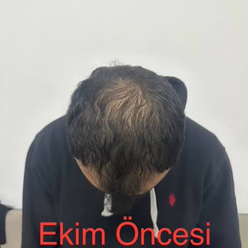 Emphair Saç Ekim Merkezi Saç Ekimi Sonrası Başarısız Sonuç ve Mağduriyet
