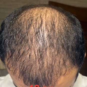 Emphair Saç Ekim Merkezi Saç Ekimi Sonrası Başarısız Sonuç ve Mağduriyet