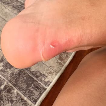 Yeni Alınan Ayakkabının Arka Kısmı Ayağımı Yaraladı, Mağaza Çözüm Sunmuyor