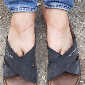 Aldığım Terlikler Ayağımı Yaraladı Mağduriyetim Giderilmiyor