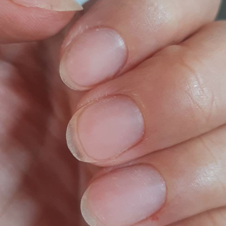 Manikür Sırasında Tırnak Ve Et Kesilmesi Nedeniyle Kötü Deneyim