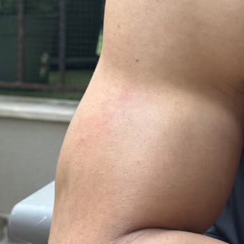 Alerjik Reaksiyona Sebep Olan Koltuk Ve Cevapsız İade Süreci