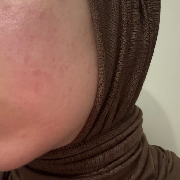 Aldığım Yüz Yıkama Jeli Cildimde Alerjik Reaksiyona Sebep Oldu