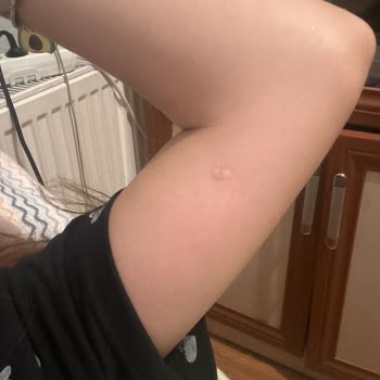 İdea Klinik Yanıltıcı Bilgi ve Kötü Sonuçlanan Ben Alımı Deneyimi