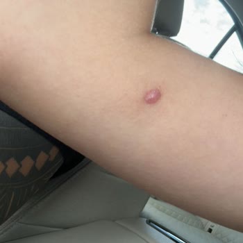 İdea Klinik Yanıltıcı Bilgi ve Kötü Sonuçlanan Ben Alımı Deneyimi