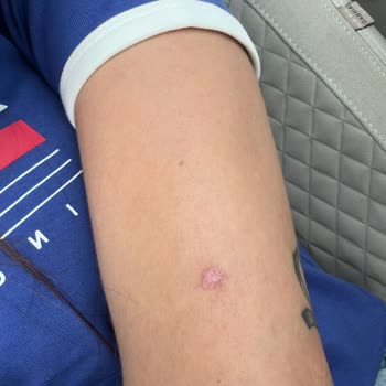 İdea Klinik Yanıltıcı Bilgi ve Kötü Sonuçlanan Ben Alımı Deneyimi