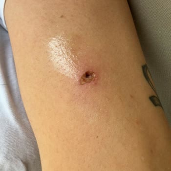 İdea Klinik Yanıltıcı Bilgi ve Kötü Sonuçlanan Ben Alımı Deneyimi