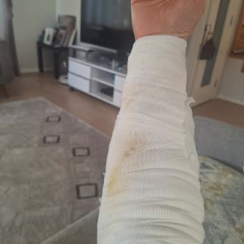 Otelde Yaşadığım Çay Kazası Sonrası İlgisizlik Ve Mağduriyet