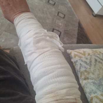 Otelde Yaşadığım Çay Kazası Sonrası İlgisizlik Ve Mağduriyet