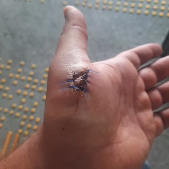 Acil Serviste Basit Dikiş Alma İşlemi İçin Yönlendirme Ve Mağduriyet