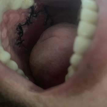 İlgisiz Cerrah Ve Başarısız İmplant Tedavisi Hayatımı Olumsuz Etkiledi