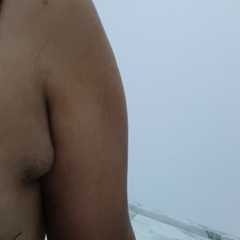 Buz Lazer Sonrası Artan Tüylenme Ve Sağlık Problemleri