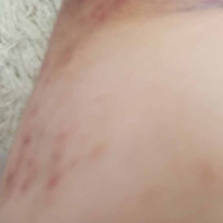 Sante Plus Ürünü Kullandıktan Sonra Kaşıntı Şikayetimiz Arttı Rahatsız Edici Boyutta