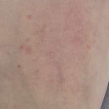 Yves Rocher Monoi Simli Yağ Cildimde Alerji Ve Egzama Yaptı, Kaşıntıdan Kurtulamıyorum