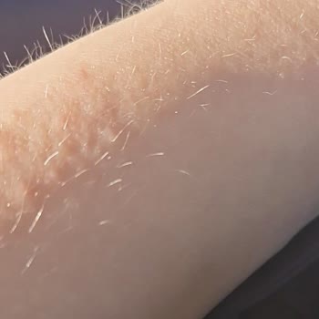 Yves Rocher Monoi Simli Yağ Cildimde Alerji Ve Egzama Yaptı, Kaşıntıdan Kurtulamıyorum