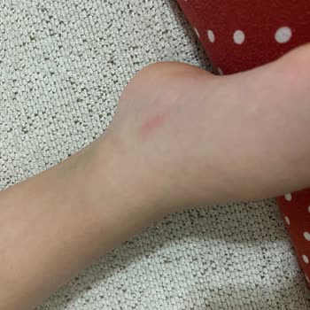 Crocs Terlik Oğlumun Ayağında Yara Yaptı Beklenmedik Hayal Kırıklığı