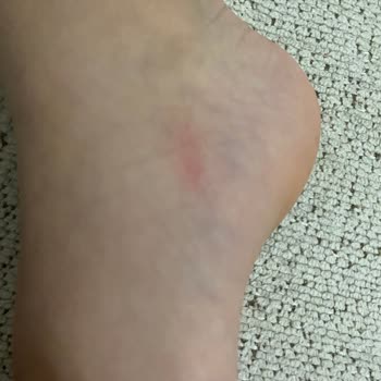 Crocs Terlik Oğlumun Ayağında Yara Yaptı Beklenmedik Hayal Kırıklığı