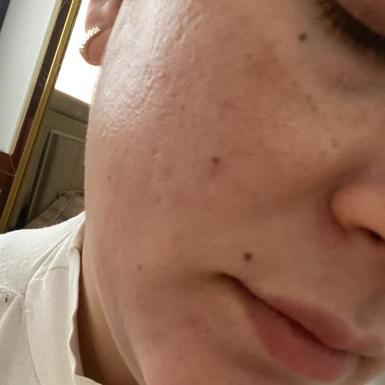 Shinest Estetik Lazer İşlemi Sonrası Yüzümde Kalıcı İzler Ve İlgisiz Yaklaşım