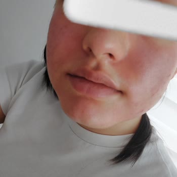 Dalin Teen Nemlendirici Krem Cildimde Şiddetli Reaksiyona Sebep Oldu