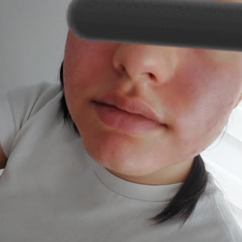 Dalin Teen Nemlendirici Krem Cildimde Şiddetli Reaksiyona Sebep Oldu