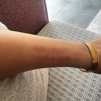 Philips Lumea Cihazı Kolumu Yaktı, Acil Dönüş Bekliyorum!