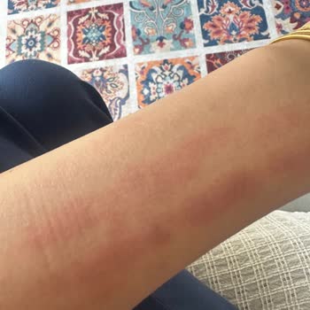 Philips Lumea Cihazı Kolumu Yaktı, Acil Dönüş Bekliyorum!