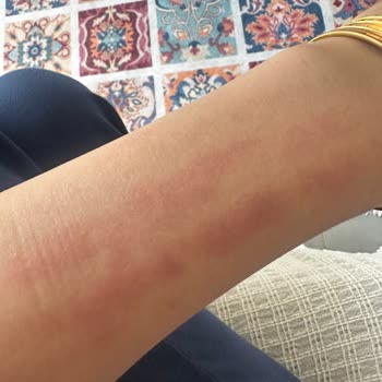 Philips Lumea Cihazı Kolumu Yaktı, Acil Dönüş Bekliyorum!