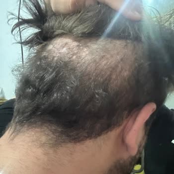 İbrahim Ceran Vip Protez Saç Takılan Protez Saç Başıma Küçük Geldi