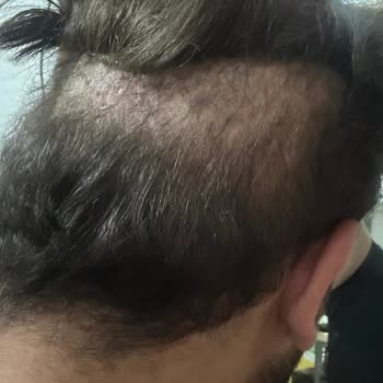 İbrahim Ceran Vip Protez Saç Takılan Protez Saç Başıma Küçük Geldi