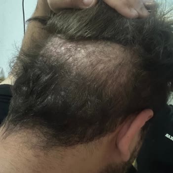 İbrahim Ceran Vip Protez Saç Takılan Protez Saç Başıma Küçük Geldi