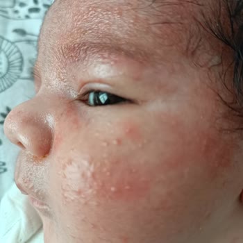 Mustela Şampuan Çocuğumda Alerjiye Sebep Oldu