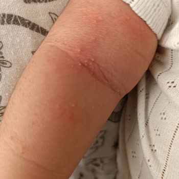 Mustela Şampuan Çocuğumda Alerjiye Sebep Oldu