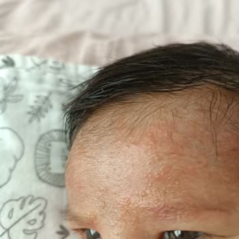 Mustela Şampuan Çocuğumda Alerjiye Sebep Oldu