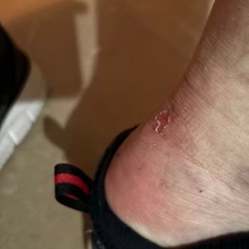 Skechers Ayakkabı Topuk Yarası Ve İlgisiz Müşteri Hizmeti Mağduriyeti