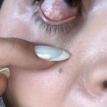 Kirpik Uygulaması Sonrası Gözlerimde Morluk Ve İlgisizlik