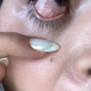 Kirpik Uygulaması Sonrası Gözlerimde Morluk Ve İlgisizlik