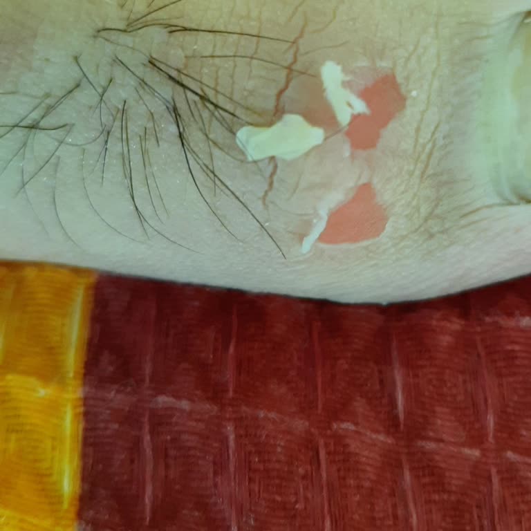 Nike Airzoom Krampon Ayağımı Yaralıyor Çözüm Bekliyorum