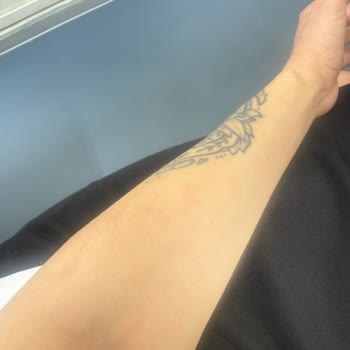 Philips 921 Lazer Kullanımı Sonrası Ciltte Sivilce Ve Kaşıntı Sorunu