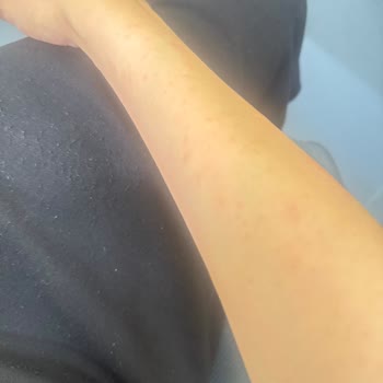 Philips 921 Lazer Kullanımı Sonrası Ciltte Sivilce Ve Kaşıntı Sorunu