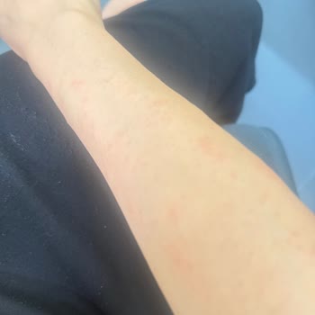 Philips 921 Lazer Kullanımı Sonrası Ciltte Sivilce Ve Kaşıntı Sorunu