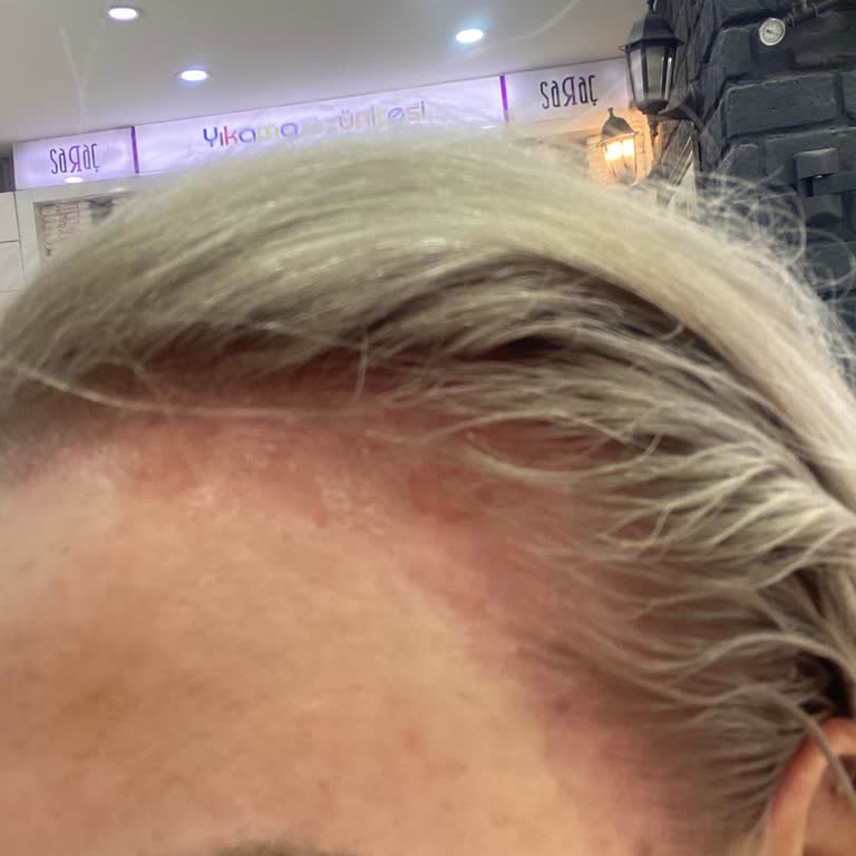 Kuaför Saraç Konya Saç Derime Zarar Verdi