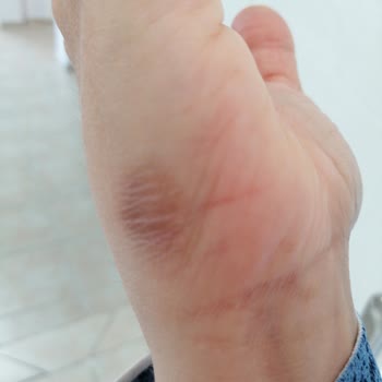 Buharlı Temizleyici Elimi Yaktı, İade Sürecinde Mağdur Edildim