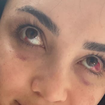 Acıbadem Hastanesi Doğum Sırasında Yaşadığım Travmatik Süreçte Hastanenin İlgisizliği